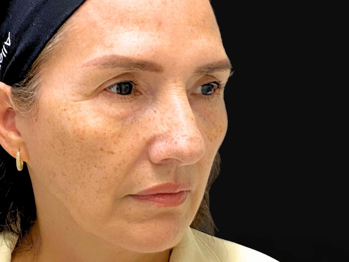 Antes contorno facial