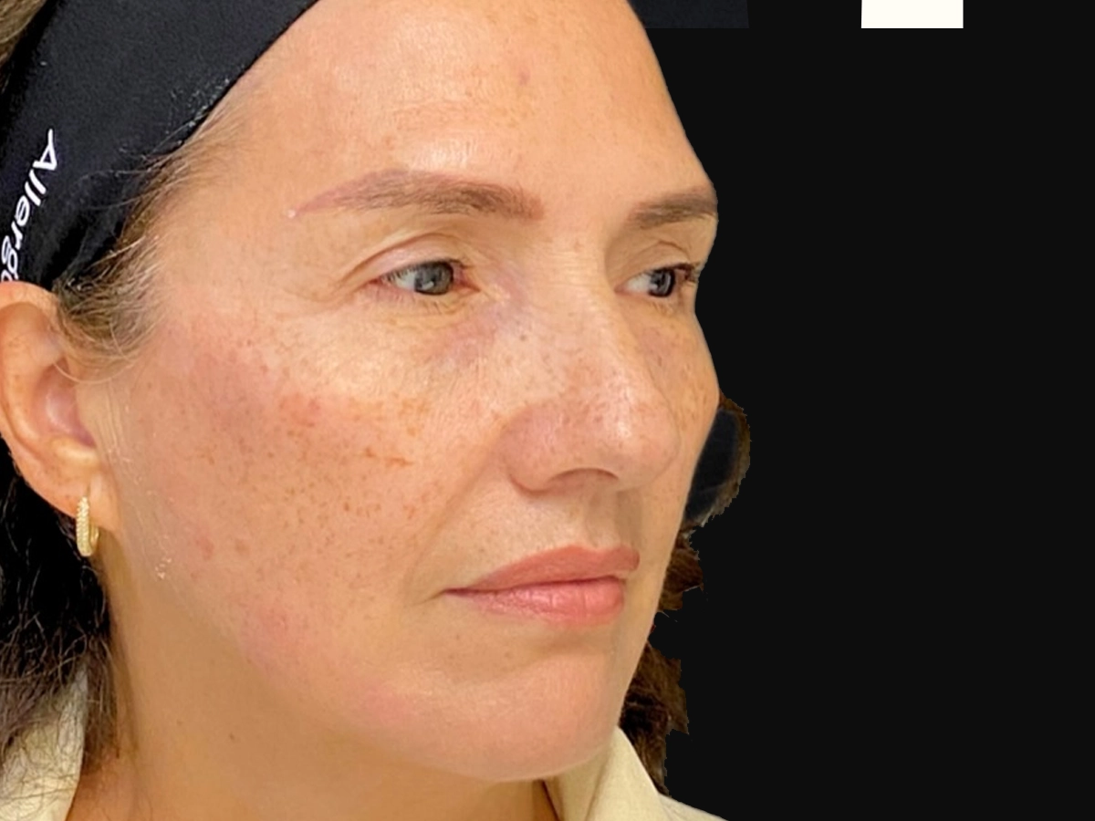Después contorno facial