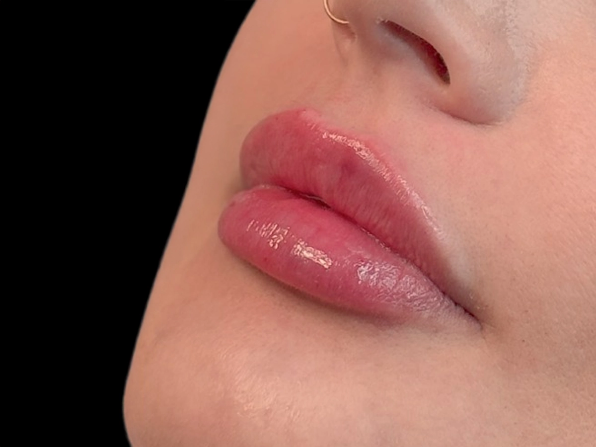 Después labios